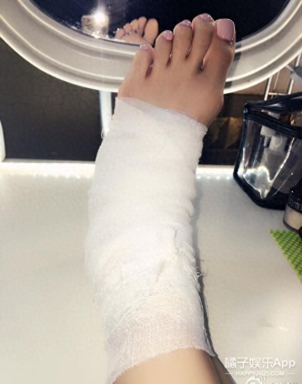 容祖儿拇指外翻，原来天天穿高跟鞋的脚是这样的